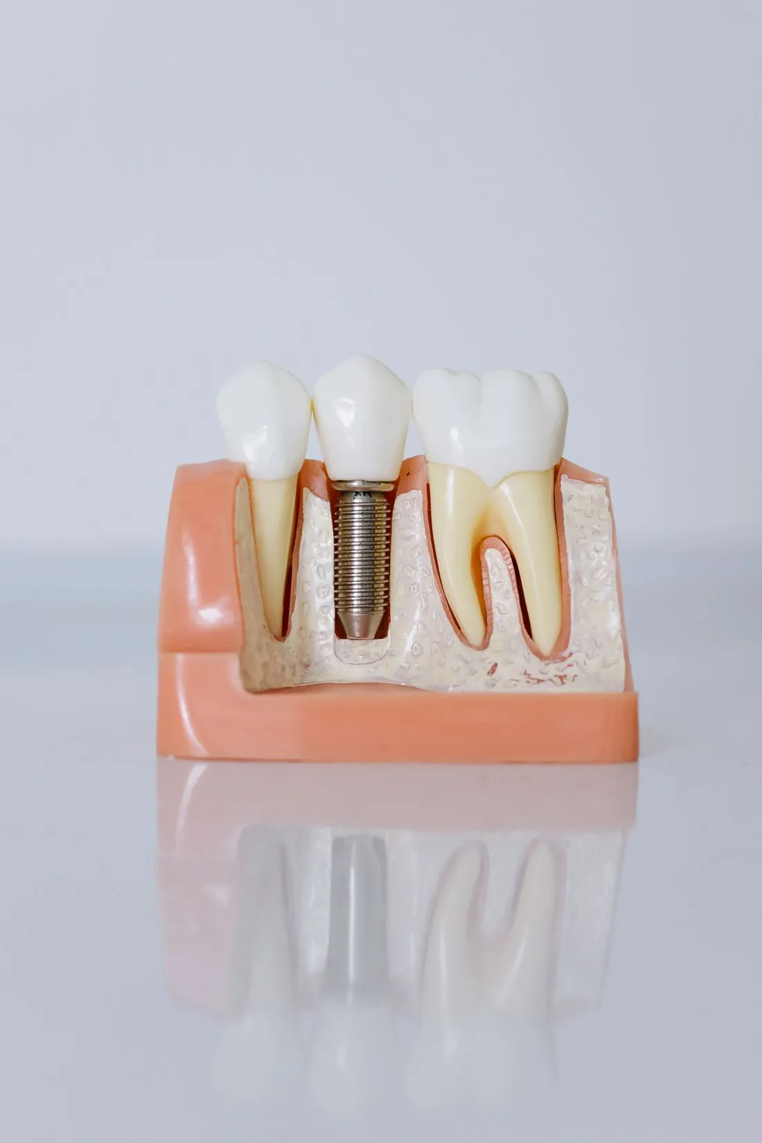 Cách chọn giữa toàn phần và bán phần