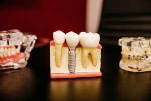 Chống chỉ định trồng implant - featured image