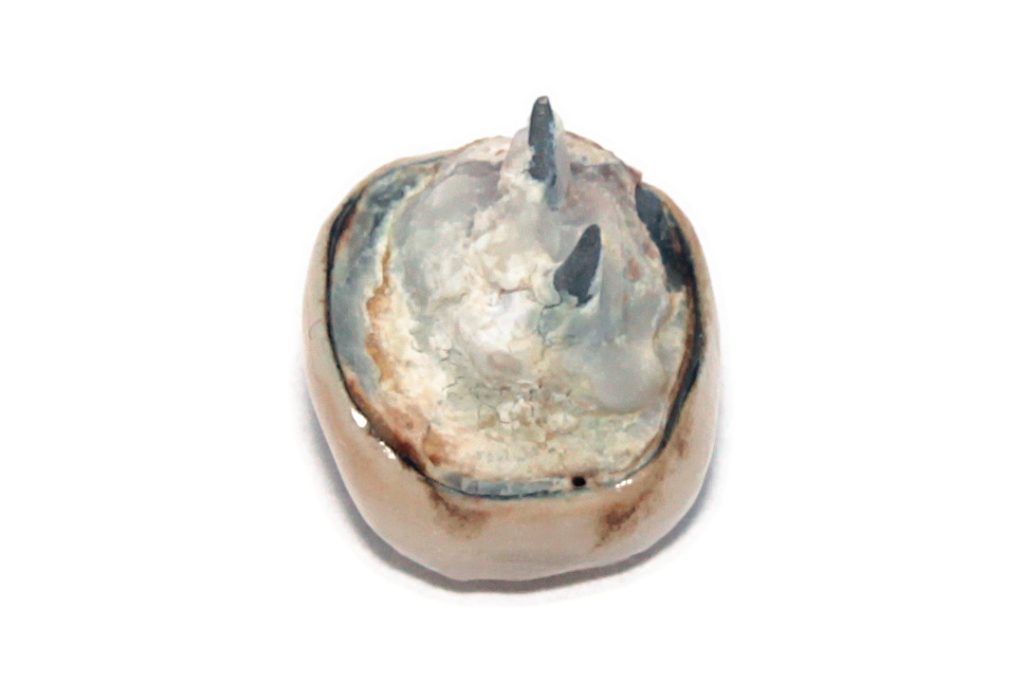 Bọc răng sứ