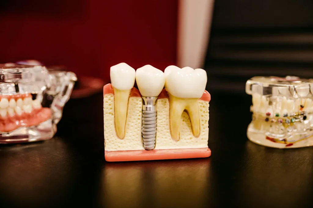 Quy trình làm cầu răng sứ gồm những bước nào