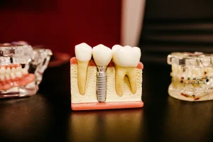 Quy trình làm cầu răng sứ gồm những bước nào