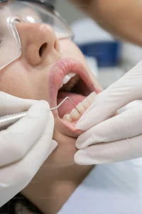 Cầu sứ có phải mài 2 răng không: ảnh hưởng & lựa chọn khác