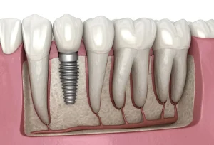 Cầu Răng Sứ Hay Implant: So Sánh Chi Tiết Ưu Nhược Điểm