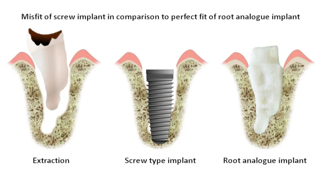 So sánh 5 dòng trụ Implant phổ biến