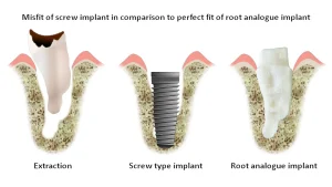 So sánh 5 dòng trụ Implant phổ biến