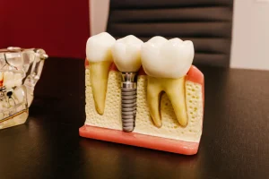 5 bước trồng răng Implant từ A-Z chuẩn y khoa