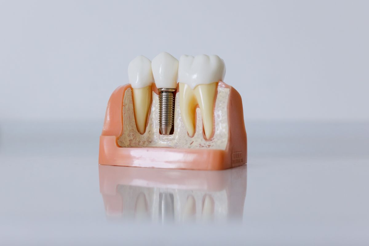 Nha khoa - Phục hình Implant