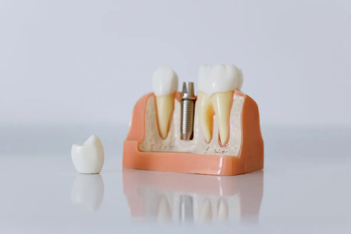 Cấu trúc Implant vs hàm tháo lắp