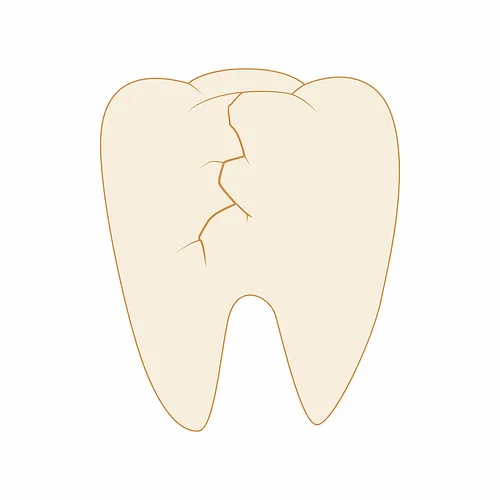 Bọc răng sứ kim loại là gì và tại sao cần bền