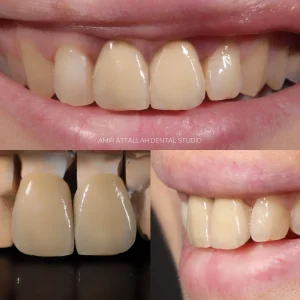 porcelain crown bad breath