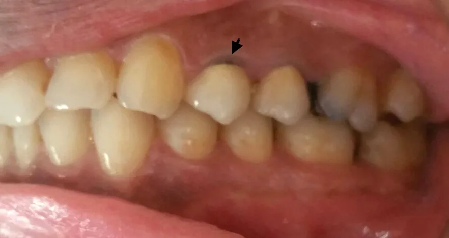 Cách chọn nha khoa uy tín và bảo vệ răng sau bọc sứ