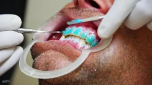 Hàm giả bị gãy: khi nào có thể sửa